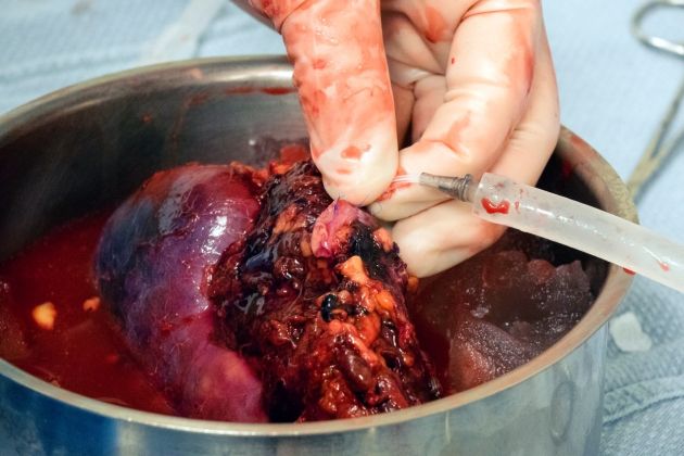 ledvica, presaditev, transplantacija, kirurgija