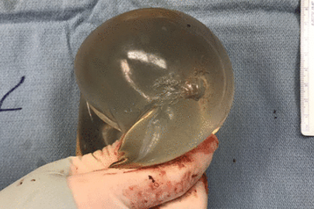 silikonski-prsni-vsadki, krogla