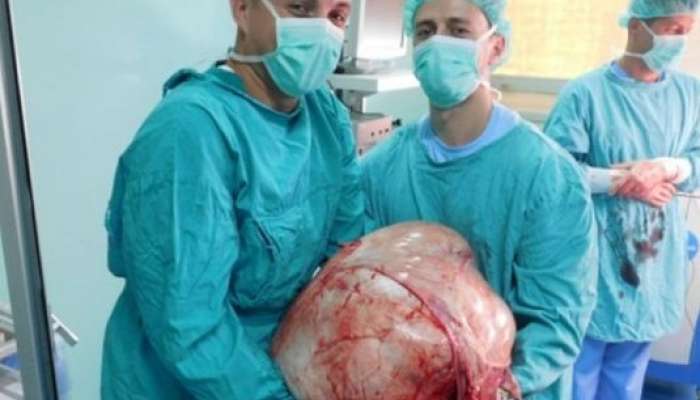 kirurgi odstranili tumor 31 kilogramov Banka Luka