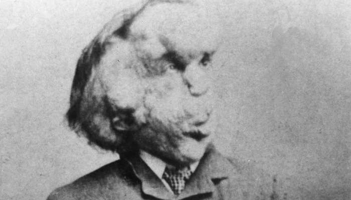 Joseph Merrick, človek slon