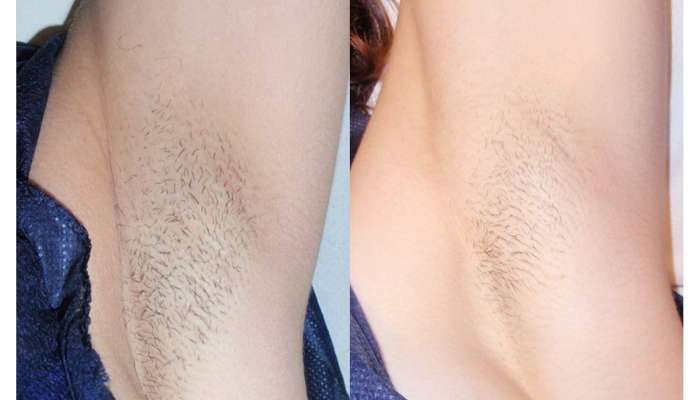 Armpits_before and after