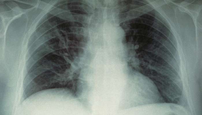 pljuča, rentgen, pljučnica