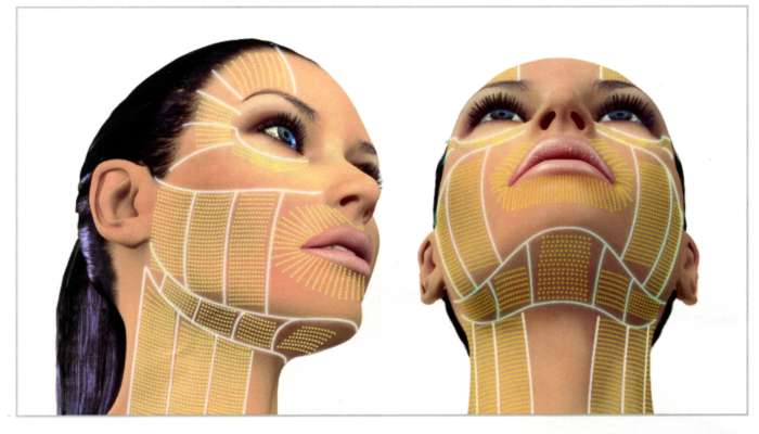 Ulthera-Facial-Thermal-Coagulation-Points-1-002