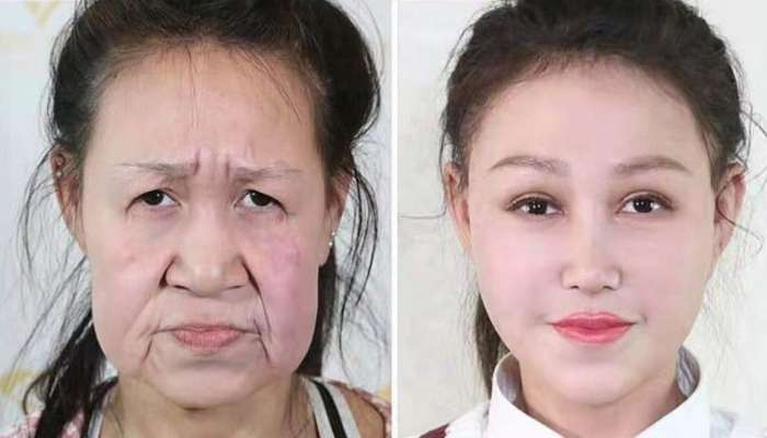 kitajska najstnica, operacija, progerija obraza