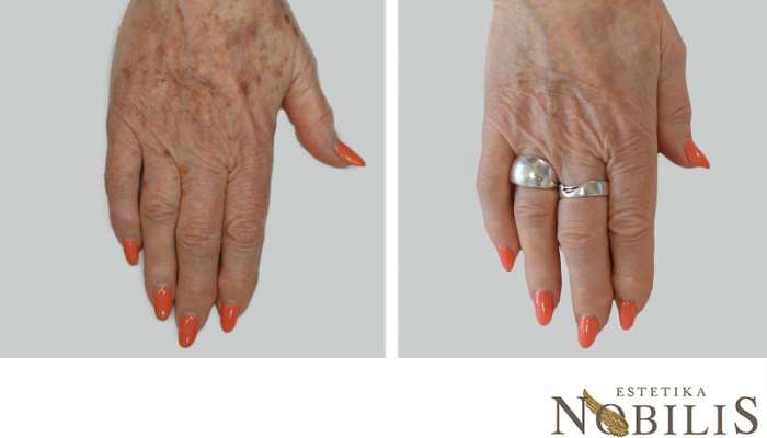 nobilis-before-after-pigmentacij-4330ae2fec