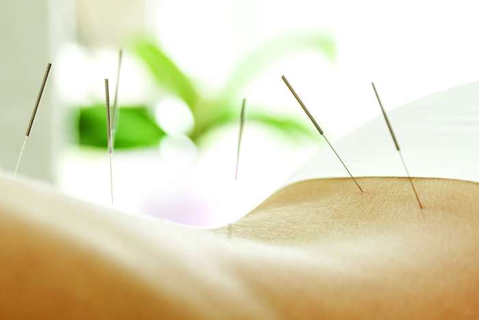 Akupunktura: zdravljenje brez stranskih učinkov