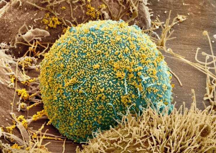 Je londonski bolnik po presaditvi matičnih celic "ozdravljen" virusa hiv?