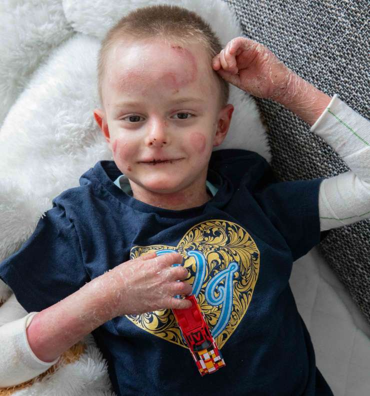 Pomagajte malemu Milošu: štiriletni deček trpi za kruto kožno boleznijo (FOTO in VIDEO)