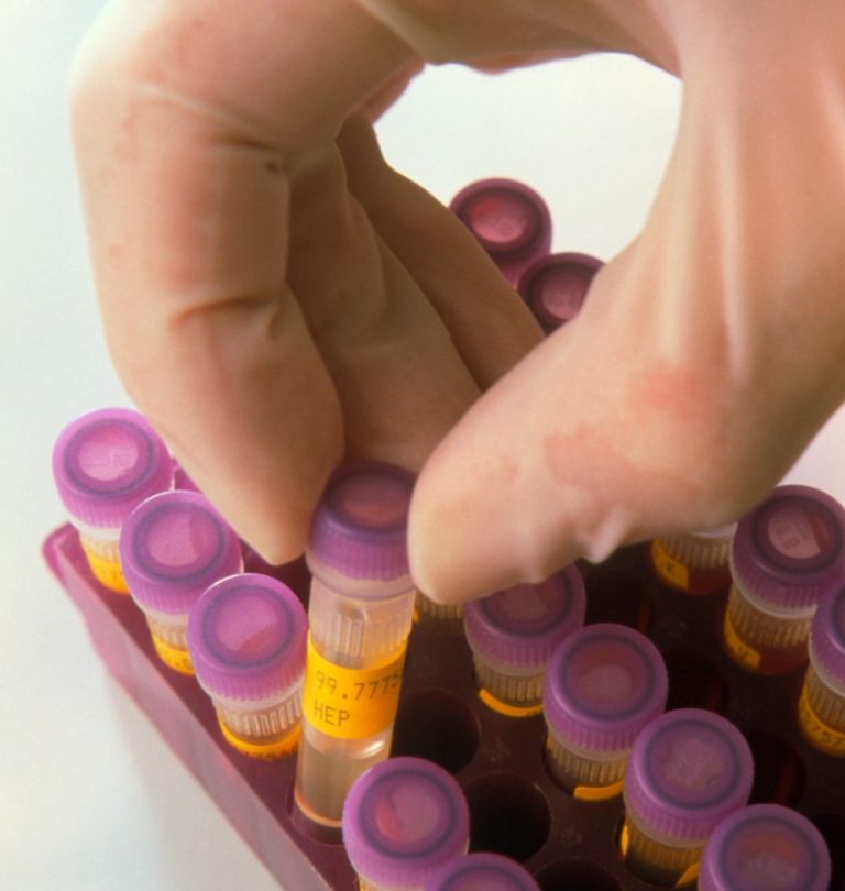 hepatitis c, hepatitis b, testiranje