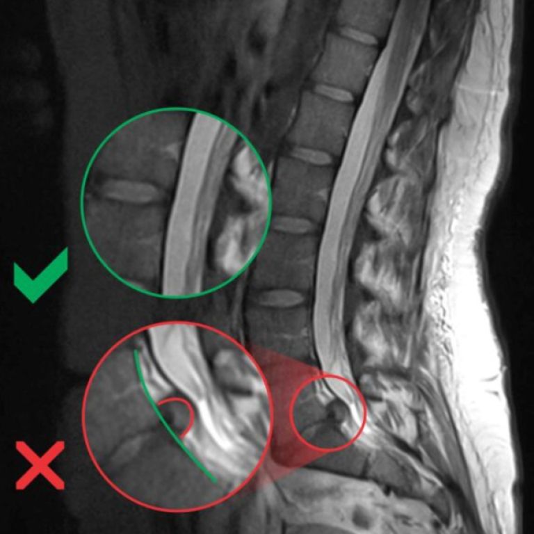 Hernija.png