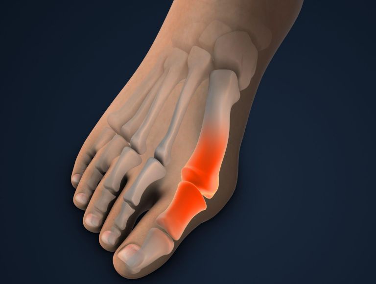 hallux valgus