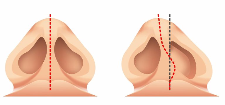 rinoplastika
