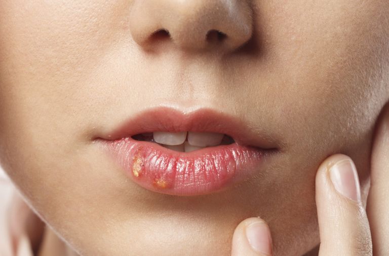 herpes, sonce