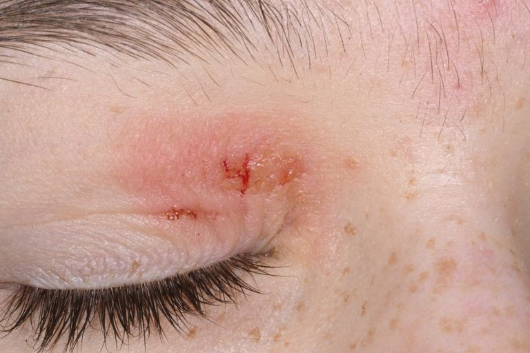 alergijski-kontaktni-dermatitis