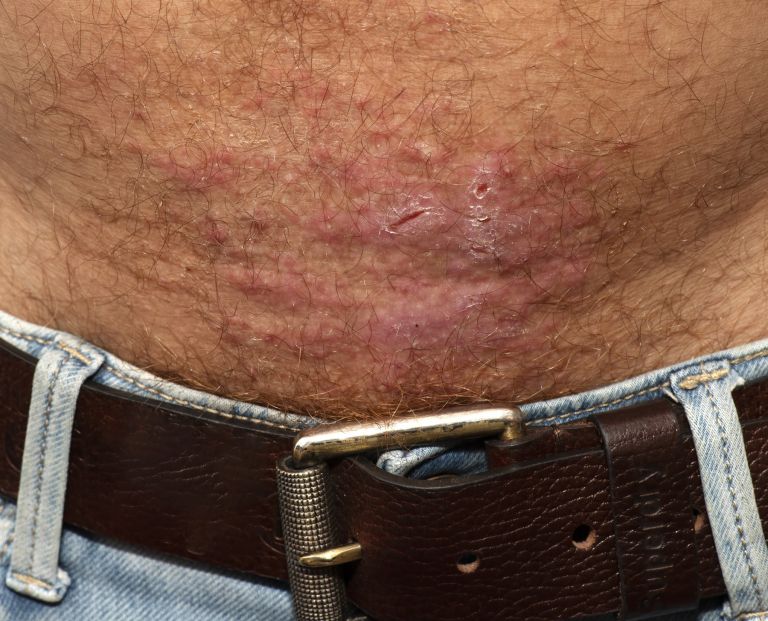 alergijski-kontaktni-dermatitis