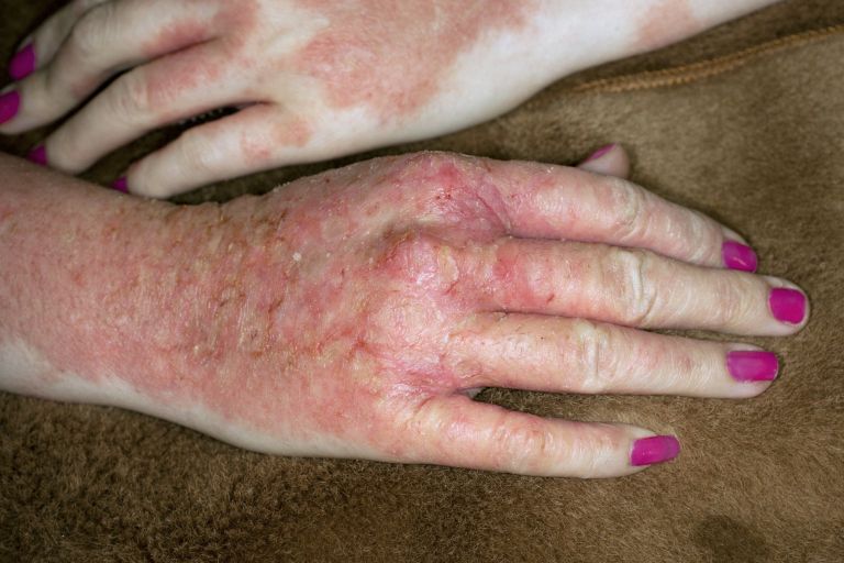 alergijski-kontaktni-dermatitis