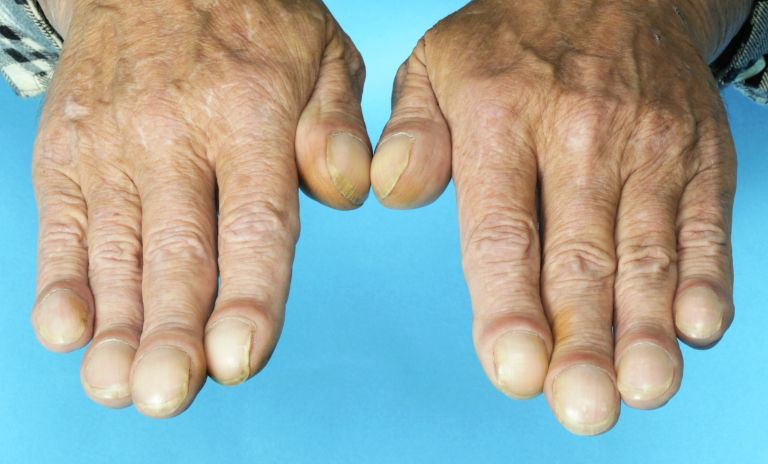 betičasti prsti, nohti