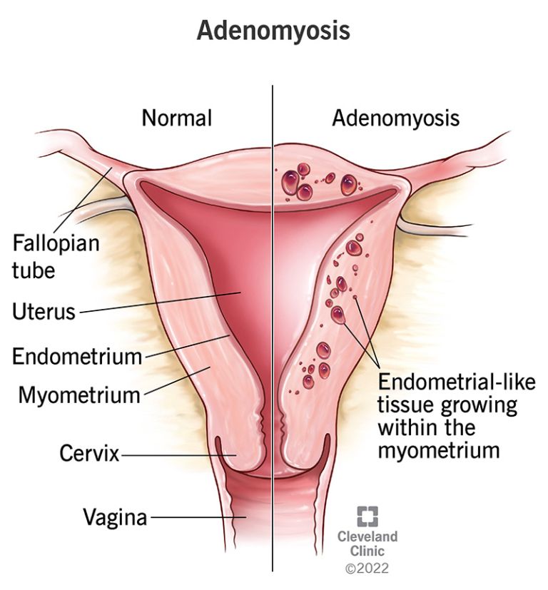 adenomioza