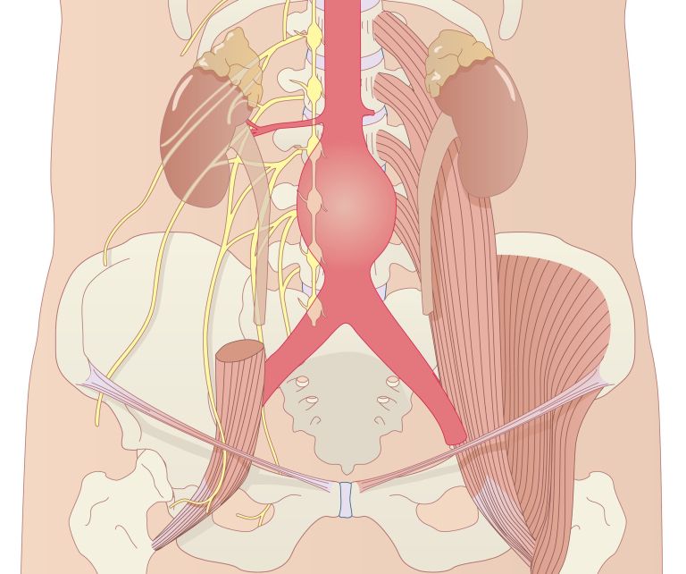 Anevrizma trebušne aorte