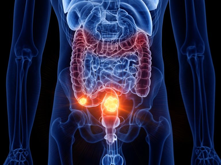 rak debelega črevesa