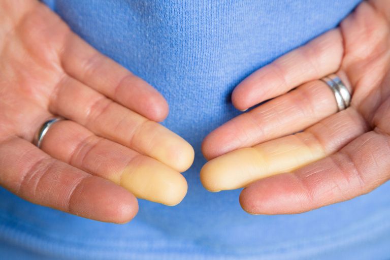 beli prsti, roke, Raynaudov sindrom