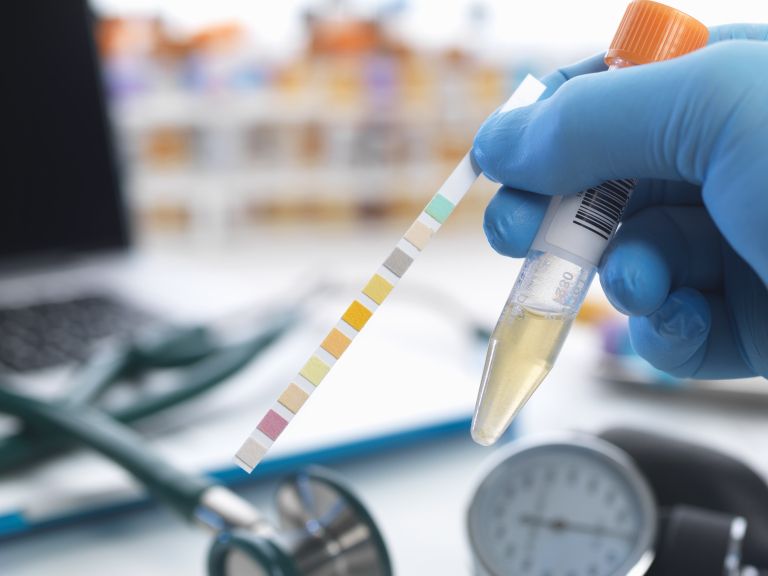 test urina, vzorec urina