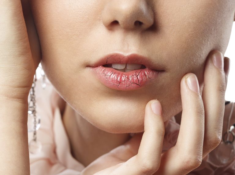 razpokane ustnice, suhe ustnice