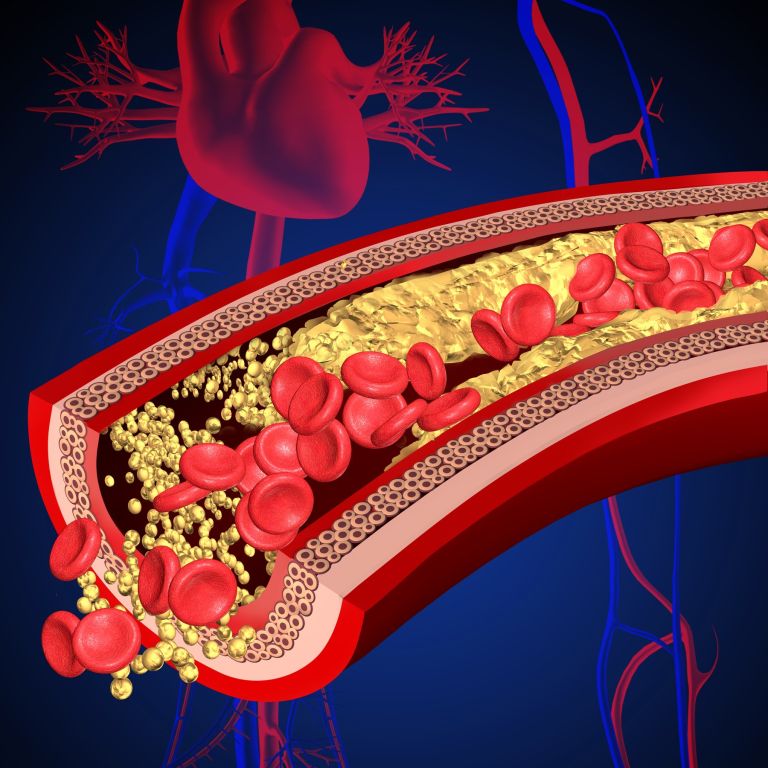 Srčno-žilne boletni, žile, holesterol