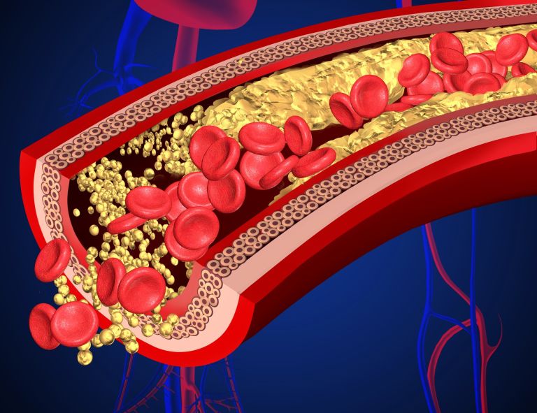 Srčno-žilne boletni, žile, holesterol