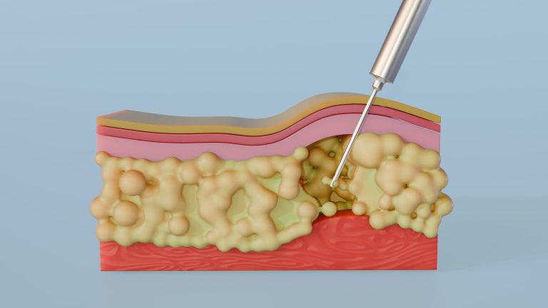 liposukcija, poseg (2).jpg