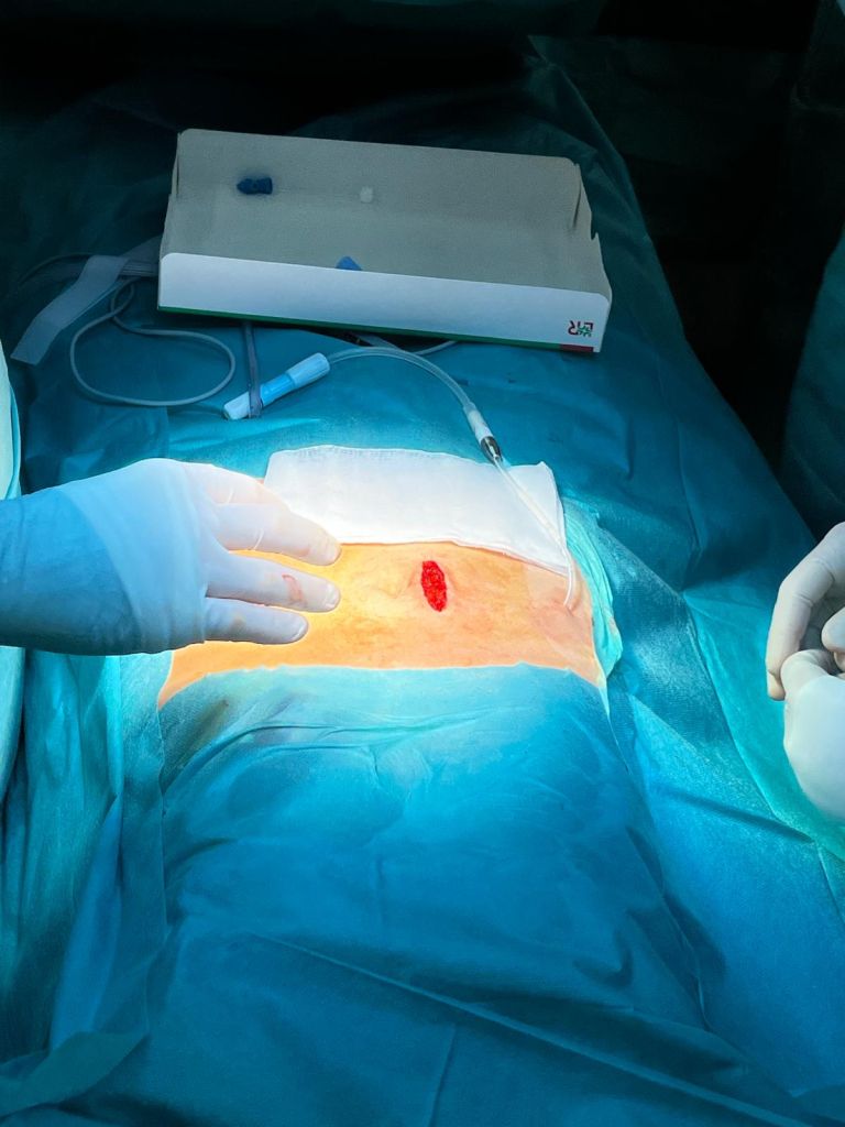 sbms, dializni-kateter