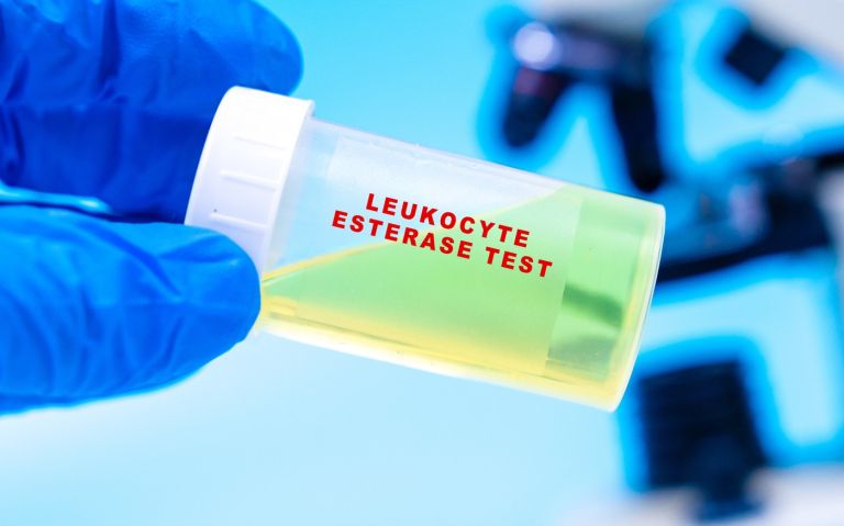 Leukocytes in urine.jpg