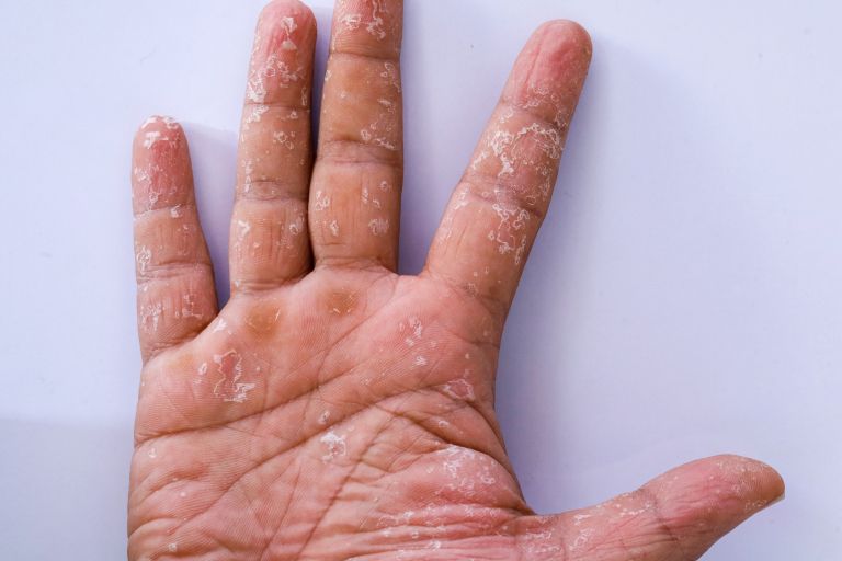 luščenje kože na dlaneh