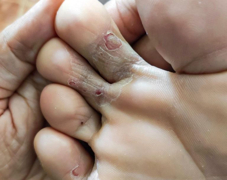 glivice, atletsko stopalo