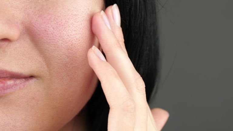 rdečica, koža, kožna bariera