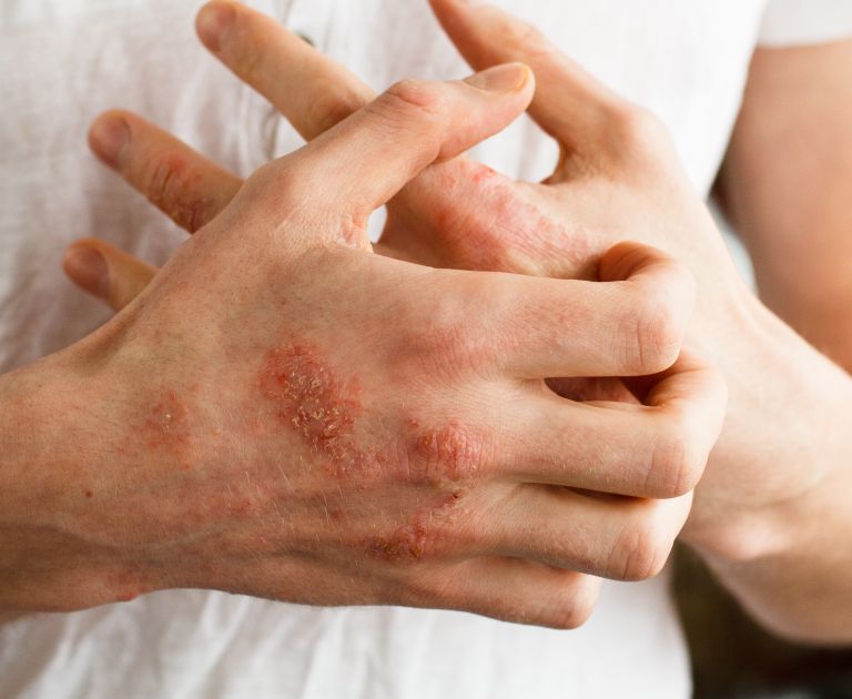 detergenti, alergicna-reakcija