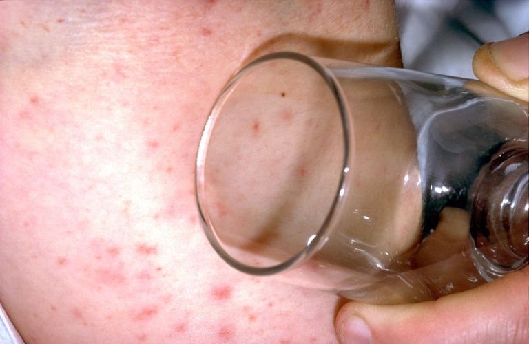 meningitis2 profimedia-0000869062.jpg