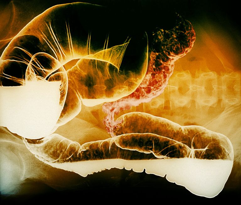 rentgensko slikanje tankega črevesa s kontrastom