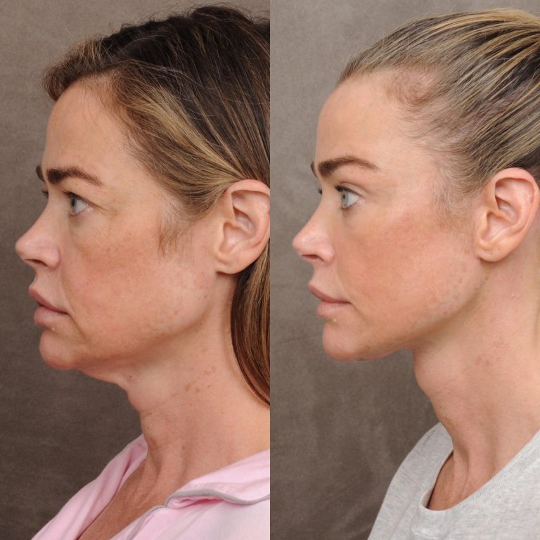 Denise Richards, lepotna operacija