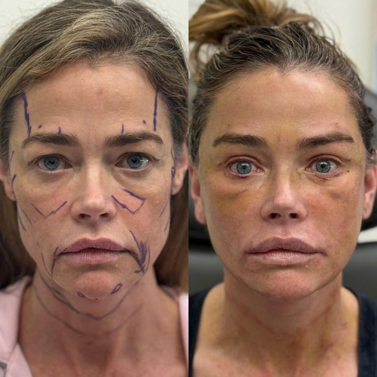 Denise Richards, lepotna operacija
