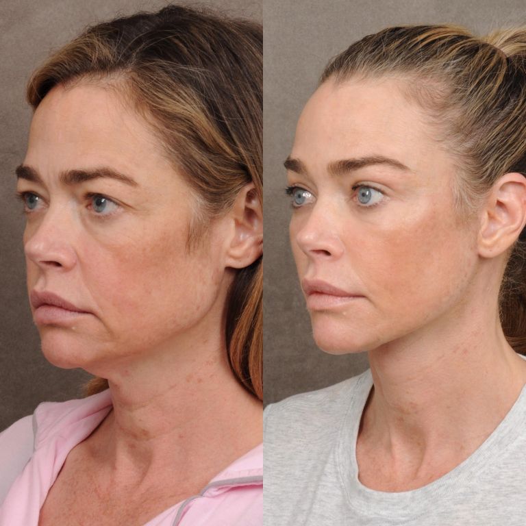 Denise Richards, lepotna operacija