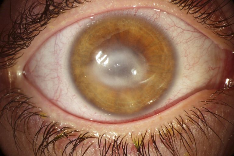 Akantamebni keratitis2.jpg