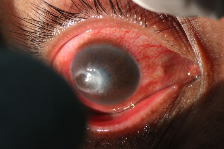 Akantamebni keratitis.jpg