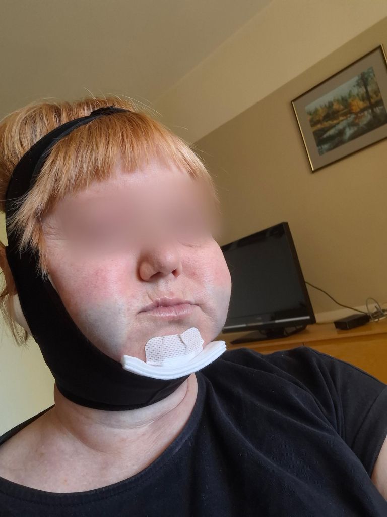 liposukcija2a.jpg