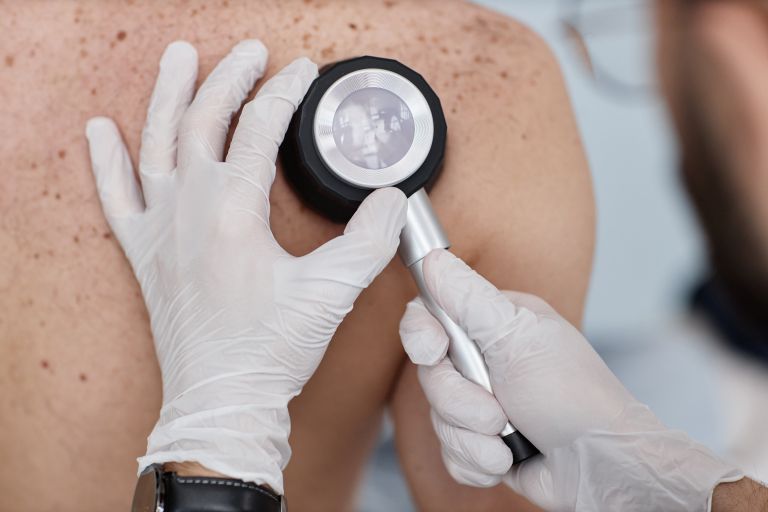 dermatolog, kožni rak
