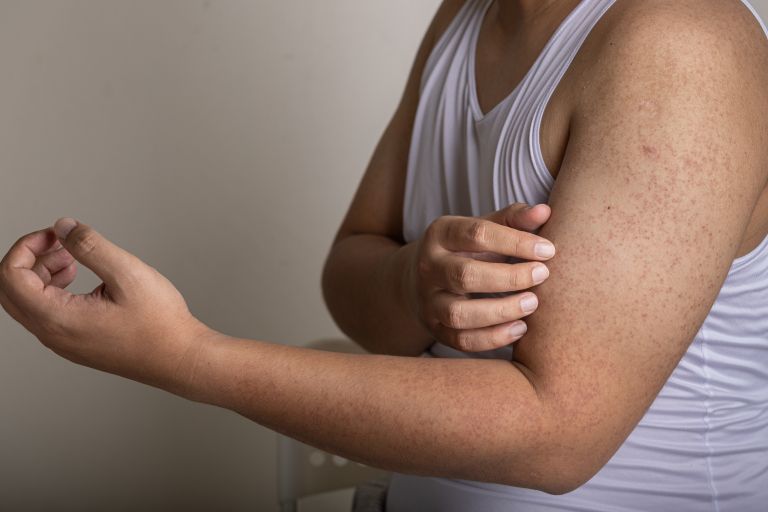 keratosis-pilaris