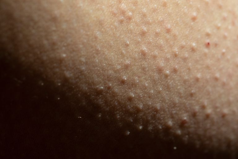 keratosis-pilaris