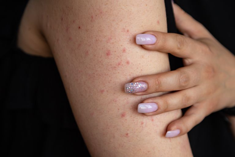 keratosis-pilaris