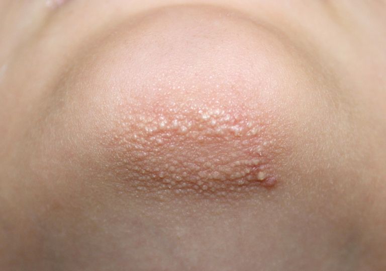keratoza pilaris.jpg