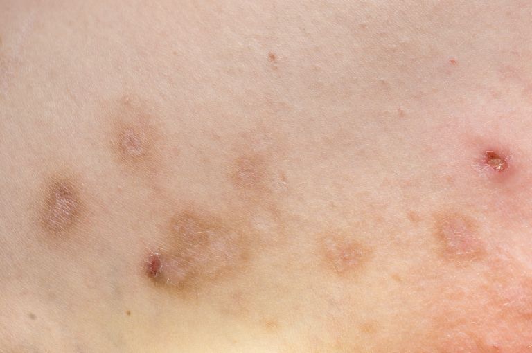 prurigo nodularis
